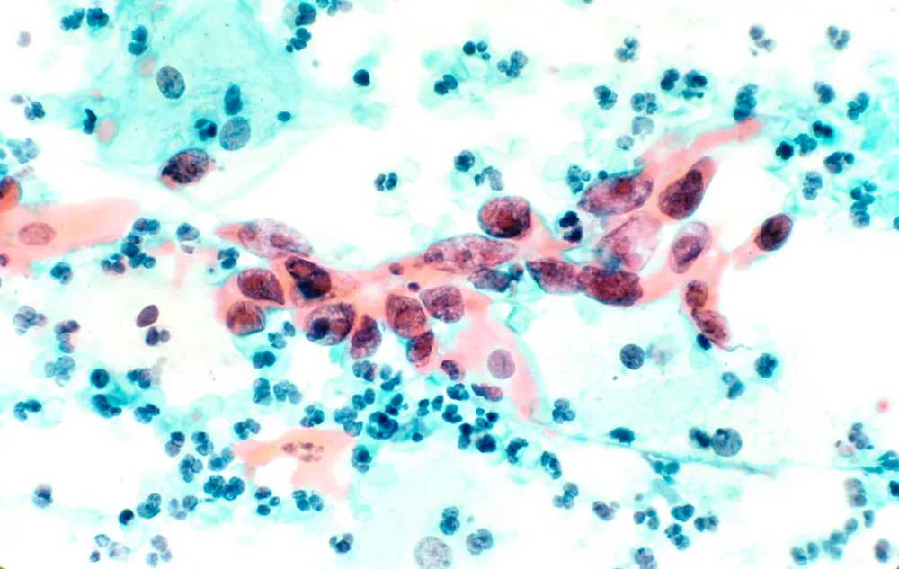 Pap-stained cytology micrograph of cervical squamous cell carcinoma