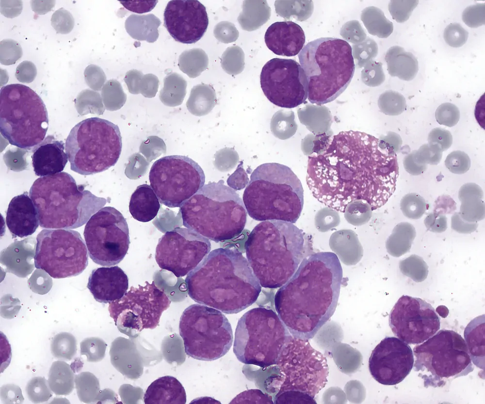 Micrograph of a bone marrow smear showing acute myeloid leukaemia