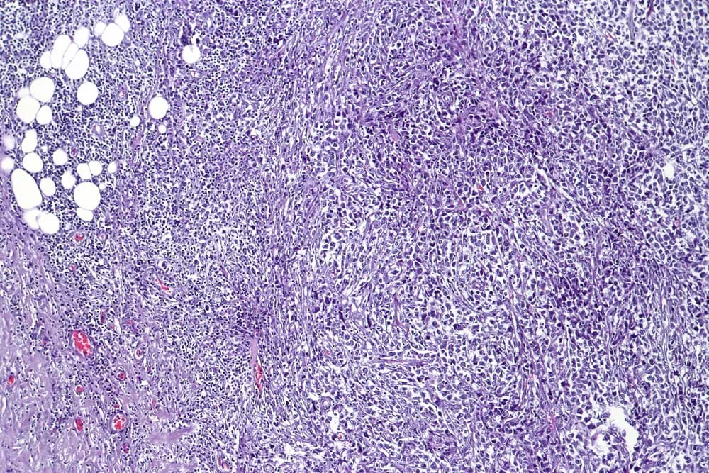 H&E-stained histological micrograph of diffuse large B-cell lymphoma