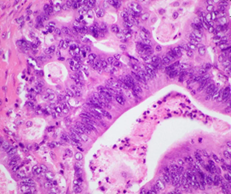 H&E-stained histological micrograph of pancreatic ductal adenocarcinoma